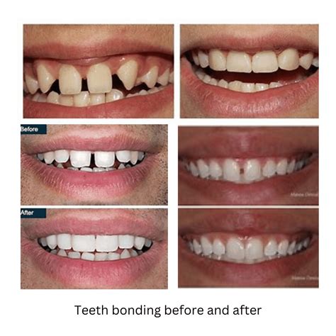 dental bonding burnsville mn|Dental Bonding Before .
